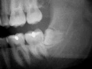 Zahnarzt Mnchen: nur auf dem Rntgenbild kann man einen verlagerten Weisheitszahn diagnostizieren.