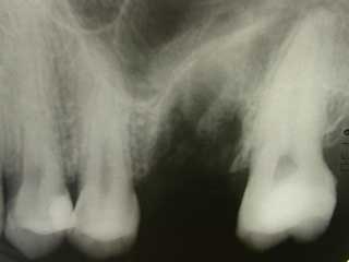 Zahnarzt Mnchen: Bitte nicht weiterschauen wenn Sie Blut nicht sehen knnen !!