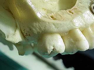 Ganz nahe an den Zahnwurzeln der Oberkieferzhne die Kieferhhle