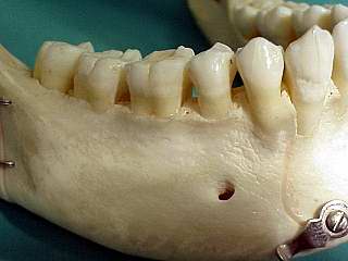 Das Loch hier an der Zahnwurzel des Backenzahnes ist der Nervaustritt der der Lippe rechts Gehfhl gibt.
