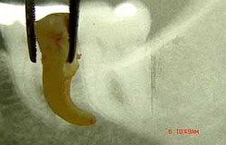 Zahnarzt München:krumme Wurzel minimalinvasiv extrahiert Zahnarzt München: krumme Wurzel minimalinvasiv extrahiert