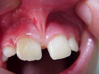 Zahnarzt Mnchen: keine Angst es tut fast nicht weh sieht nur schlimm aus ! Lippenbndchen machen unschne Spalten zwischen den Frontzhnen. (Diasthema)