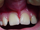 Zahnarzt Mnchen: Lippenbndchen strahlt tief ein