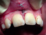 Zahnarzt Mnchen: Lippenbndchen Operation