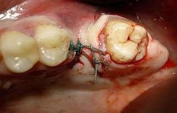 Zahnarzt München: offene Kiferhöhle MAV Verschluss Zahnarzt München: offene Kieferhöhle minimalinvasiv MAV Verschluss