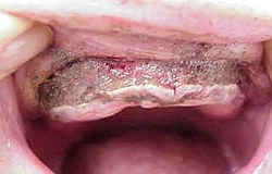 Zahnarzt München: Kieferoperation zum Prothesenhalt Zahnarzt München: Kieferoperation zum Prothesenhalt