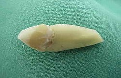 Zahnarzt München: Wurzelresektion letzte Hoffnung Zahnarzt München: Wurzelresektion letzte Hoffnung