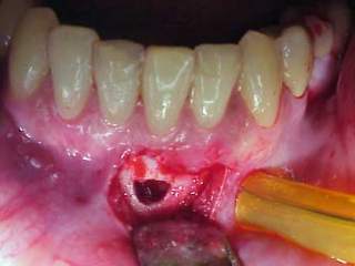Zahnarzt München: Die Wurzelresektion vernichtet den Knochen, den man für ein Implantat brauchen würde.