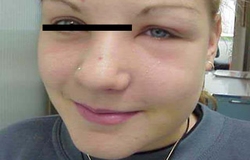 Zahnarzt München: dicke Backe Zyste Kiefer Zahn Entfernung Zahnarzt München: Zyste Kiefer Zahn Entfernung