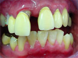 Zahnarzt Mnchen: auch das konnte man wunderbar reparieren mit knstlichen Zahnkronen Metallkeramikkronen