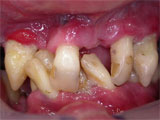 Zahnarzt Mnchen: herausnehmbarer preiswerter Zahnersatz sthetisch