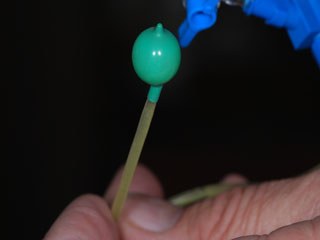 Knochenaufbau Kieferhöhle Sinuslift mit Ballon