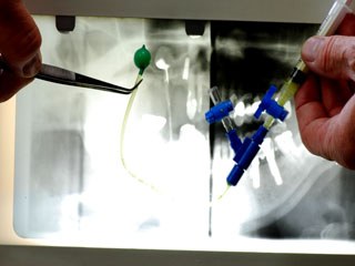 Knochenaufbau Kieferhöhle Sinuslift