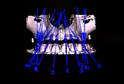 Zahnarzt München: computernavigierte Implantate mit Robodent Zahnarzt München: computernavigierte Implantate mit Robodent