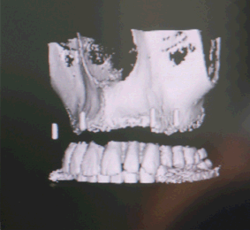 Zahnarzt München: Robodent computernavigierte Implantation Computernavigation Bohrschiene Bohrschablone Zahnarzt München: Robodent computernavigierte Implantation Computernavigation Bohrschiene Bohrschablone