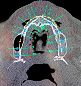 Zahnarzt München: Robodent computernavigierte Implantation Computernavigation Bohrschiene Bohrschablone