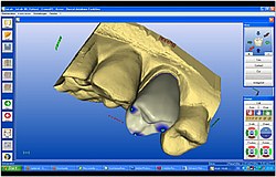Zahnarzt München: Zirkon nichtallergisch verträglich ästhetisch Zahnfarbe Zahnarzt München: Zirkon nichtallergisch verträglich ästhetisch Zahnfarbe