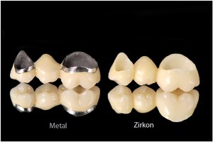 hochfester Zahnersatz aus Zirkon