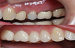 Zahnarzt München: hochfeste zahnfarbene Krone aus Zirkon allergiefrei metallfrei kein Metallrand hochfeste zahnfarbene Krone aus Zirkon allergiefrei metallfrei kein Metallrand