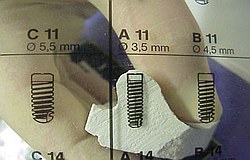 Zahnimplantat Mnchen: Implantatplanung Implantat Vorbereitung