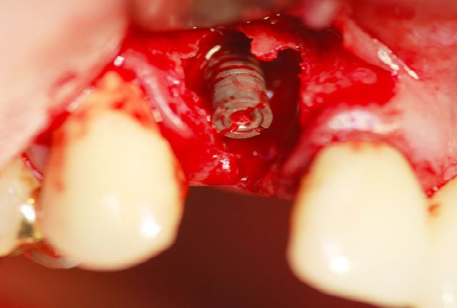 Sofortimplantat dirket in Zyste verspricht schnelle Heilung