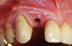 Sofort Implantat direkt in Zyste Sofort Implantat direkt in Zyste