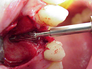Zahnimplantat Mnchen: Kunstknochen eigener Knochen gezchteter Knochen Rinderknochen synthtetischer Knochen Knochenersatzmaterialen