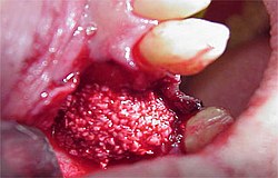 Zahnimplantat Mnchen: Knochen aus einer anderen Krperregion Rindknochen Spenderknochen gezchteter Knochen synthetischer Knochen