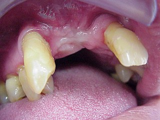 Zahnimplantat Mnchen: Knochentransplantaion aus regio Weisheitszahn