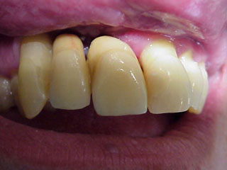 Zahnimplantat Mnchen: Wieder Zhne Gott sei Dank