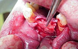 Zahnimplantat Mnchen: Knochentransplantation. Der Weisheitszahn htte sowieso raus gemusst.