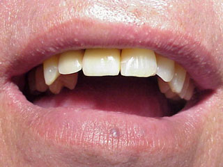 Zahnimplantat Mnchen: Der Zahnarzt hat geschwitzt der Patient kaum etwas gesprt.