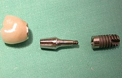 Übersicht Implantate Dr. Junk Zahnarzt München Übersicht Implantate Dr. Junk München