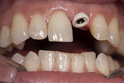 Zahnimplantat Mnchen: Welcher ist der Implantatzahn ??