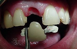 Zahnimplantat Mnchen: Schwupps da ist der Zahn wieder da !