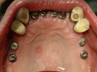 Zahnimplantat Mnchen: Bei so vielen neuen Zhnen geht das Beissen wieder richtig flott
