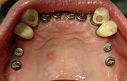 Implantat statt herausnehmbar Implantat statt herausnehmbar