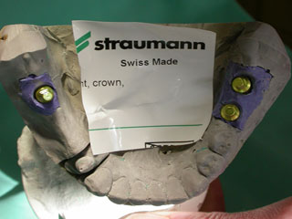 Zahnimplantat München: Im Unterkiefer ist herausnehmbarer Zahnersatz besonders wackelig Zahnarzt München Dr. Junk