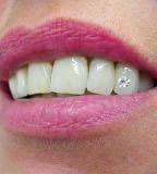 Bleaching Brillant Zahnschmuck Zahnarzt München Bleaching Brillant Zahnschmuck Zahnarzt München