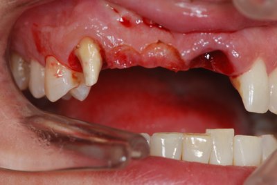 Zahnimplantat Frontzahnverlust | Sofortimplantat Zahn sofort ersetzen München
