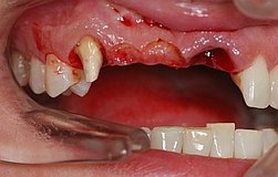 Zahnimplantat schneller Ersatz verfaulte Zähne unter Frontzahnbrücke schneller Ersatz verfaulte Zähne unter Frontzahnbrücke