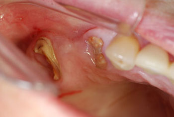 Sofortimplantat: minimalinvasives Zahnimplantat ersetzt Zahnwurzel sofort nach Zahnextraktion München