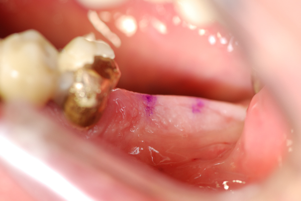 minimalinvasives Zahnimplantat wenig Schmerz und Schwellung bei Zahnarzt München<