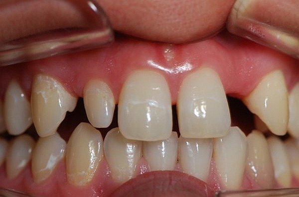 Zahnimplantation für nichtangelegte fehlende Zähne Zahnarzt München