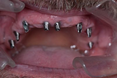 Zahnimplantate: alle Zähne auf einmal ersetzen und wieder richtig beissen können- Preise Kosten - München 
