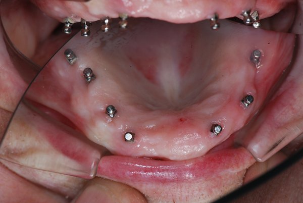 Zahnimplantat München besserer Prothesenhalt durch Zahnimplantate