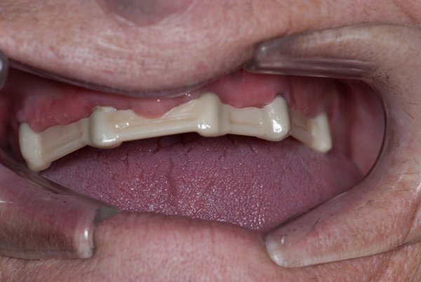 besserer Zahnhalt durch Zahnimplantat und Stegversorgung