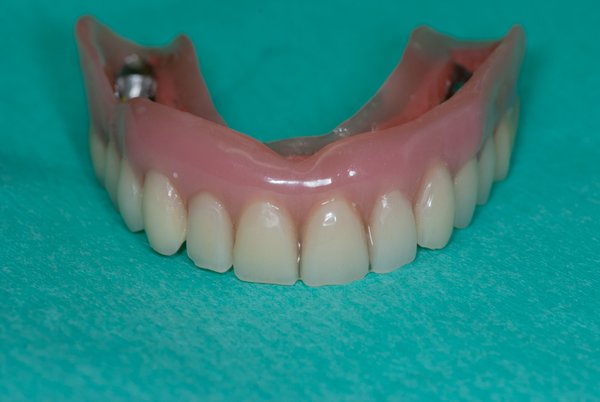 Zahnimplantat getragene Stegprothese