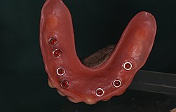 besserer Prothesenhalt durch Zahnimplantat Haltevorrichtung