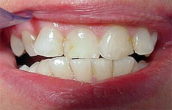 schiefe Zähne mit Kunststofffüllung begradigen Zahnarzt München